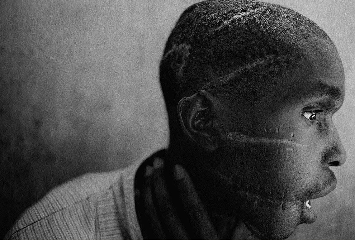 A young Hutu man's profile reveals several long, deep scars across his scalp and face in Rwanda.