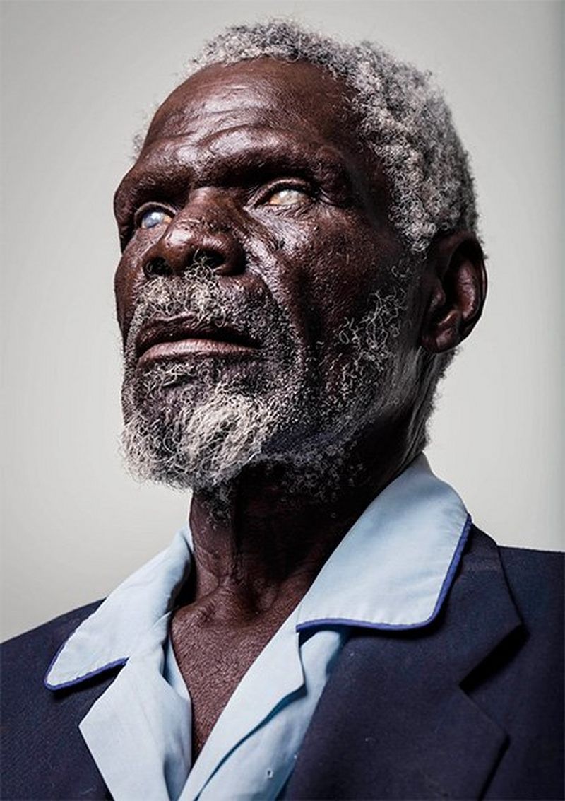 A portrait of a smartly dressed older man with corneas that are clouded over with cataracts.