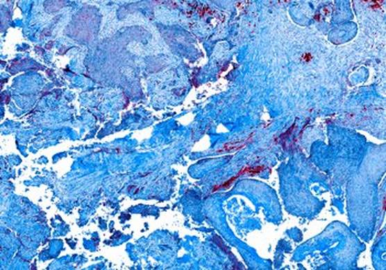 Research sample slide of tumour tissue where cells have been stained for different proteins using a fluorescently tagged antibody. Presented as false colour blue/red image on white background.