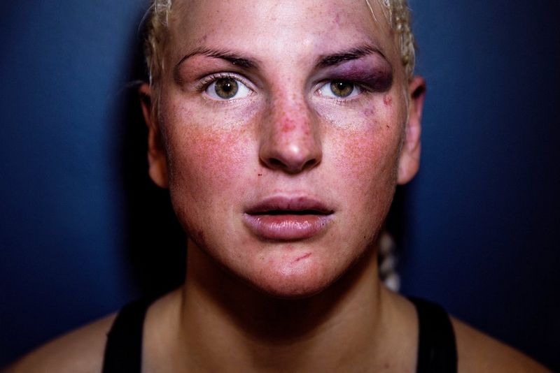 La combattante de MMA Camilla Hinze fixe l'appareil photo avec un regard intense. Son œil gauche est contusionné et enflé.