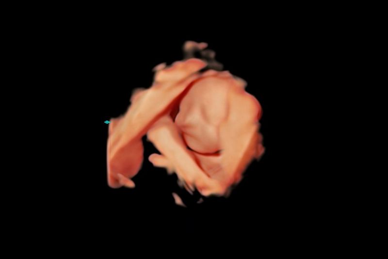 Baby Scan image from ultrasound practitioner Bill Smith showing no VI impairment simulation