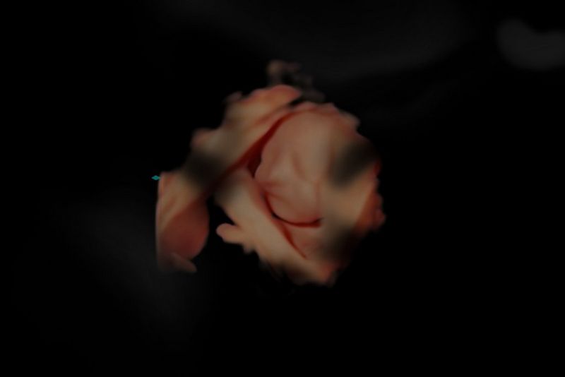 Baby Scan image from ultrasound practitioner Bill Smith showing VI impairment of moderate diabetic retinopathy