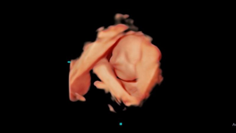 Ultraschallbild eines Babys von Ultraschall-Spezialist Bill Smith.