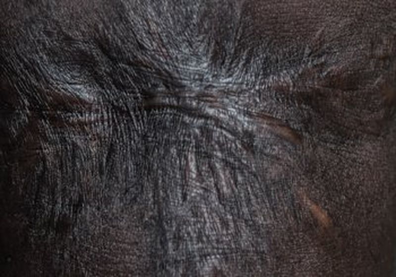 A close-up of a thick scar on black skin, showing the detail of the skin’s tension lines and scar tissue.